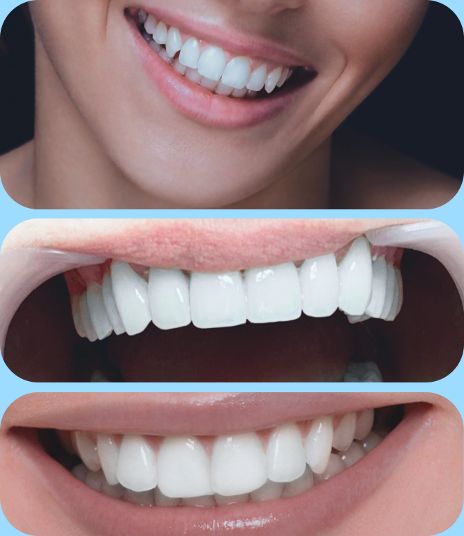 Зубной имплант