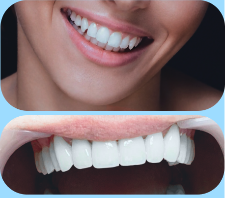 Зубной имплант